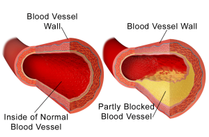 Cholesterol in Blood