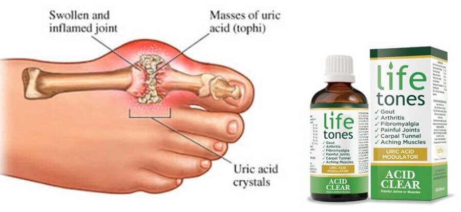 description of gout