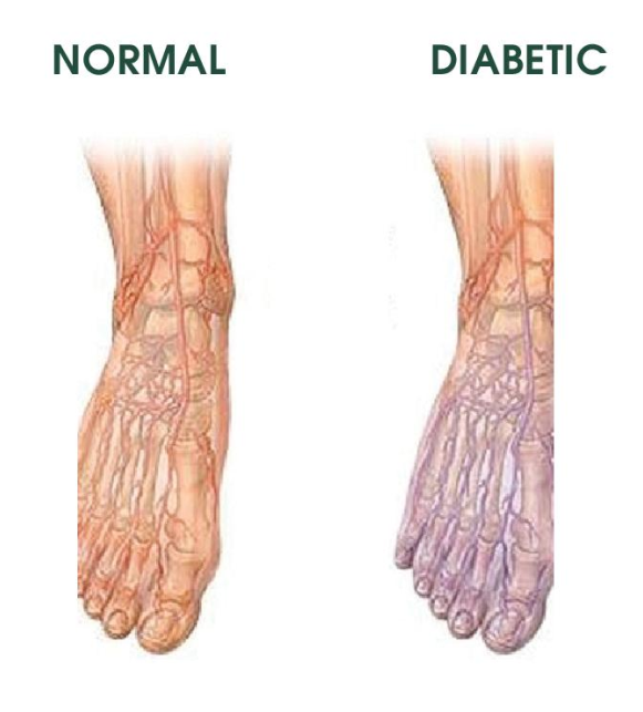 Blood vessel damage in the feet may cause tissue damage. 