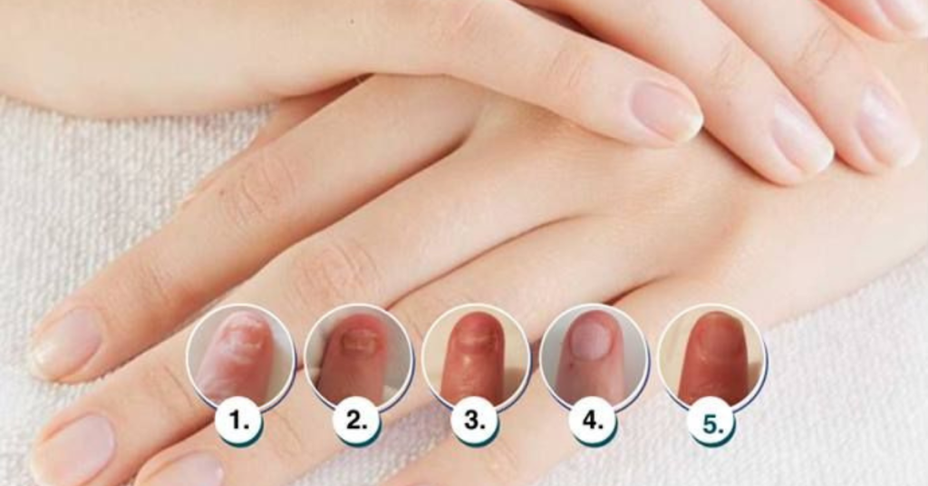 Actual results after using Nail Fix antifungal treatment